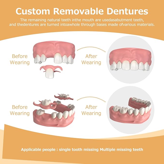 Partial Dentures - Dentures for Missing Teeth & Gaps - Lightweight & Unbreakable Replacement Teeth for Men & Women (5 Teeth)